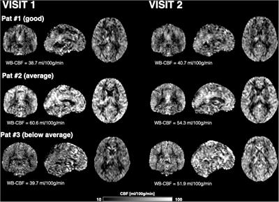 Evaluation of Cerebral Blood Flow Measured by 3D PCASL as Biomarker of <mark class="highlighted">Vascular Cognitive Impairment and Dementia</mark> (VCID) in a Cohort of Elderly Latinx Subjects at Risk of Small Vessel Disease